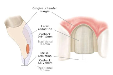 dental veneer